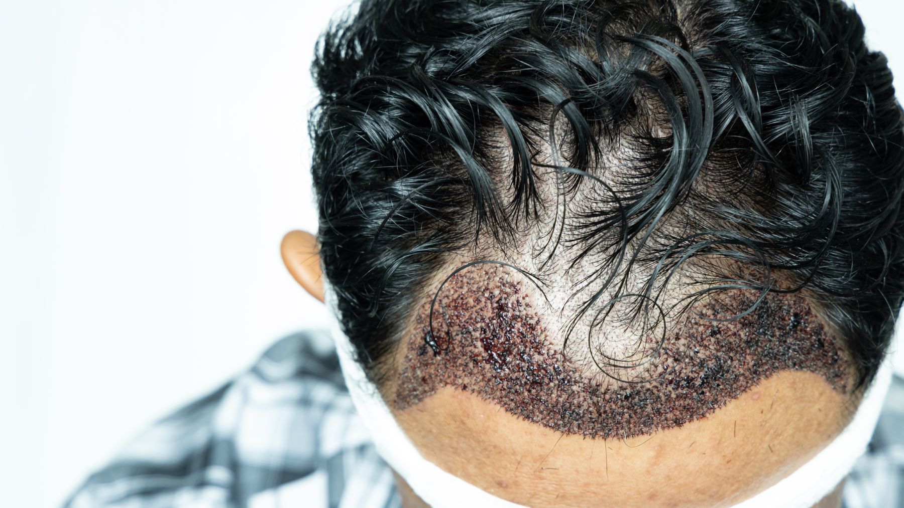 Hair transplant donor area not bandaged