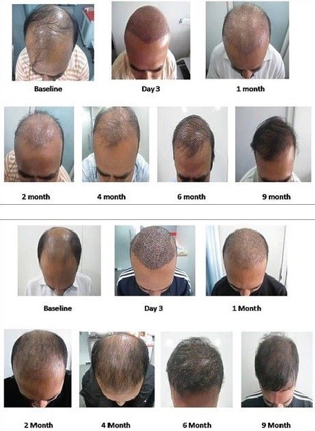 Hair transplant recovery with and without PRP treatment