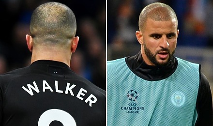 Kyle Walker Hair Transplant