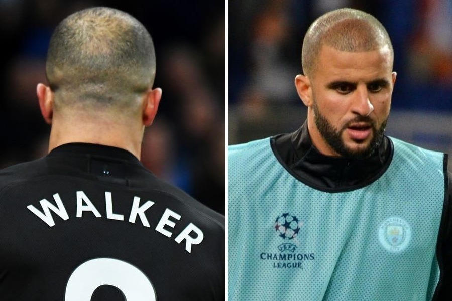 Kyle Walker Hair Transplant