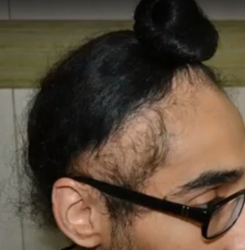 Male patient with traction alopecia