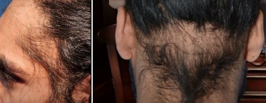 Male patients with traction alopecia