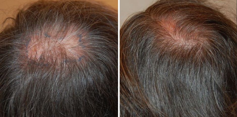 Man before and after Wimpole Clinic hair transplant