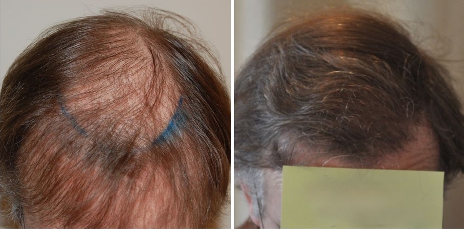 Man before and after hair transplant