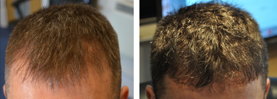 Man before and after his hair transplant