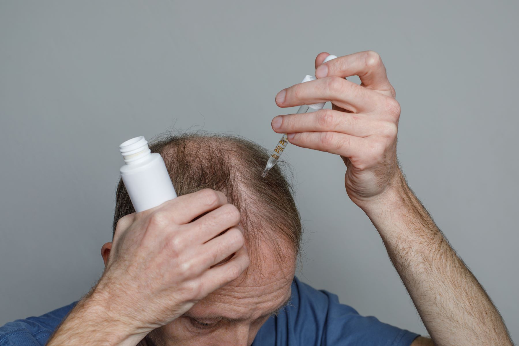 Man using hair loss medication