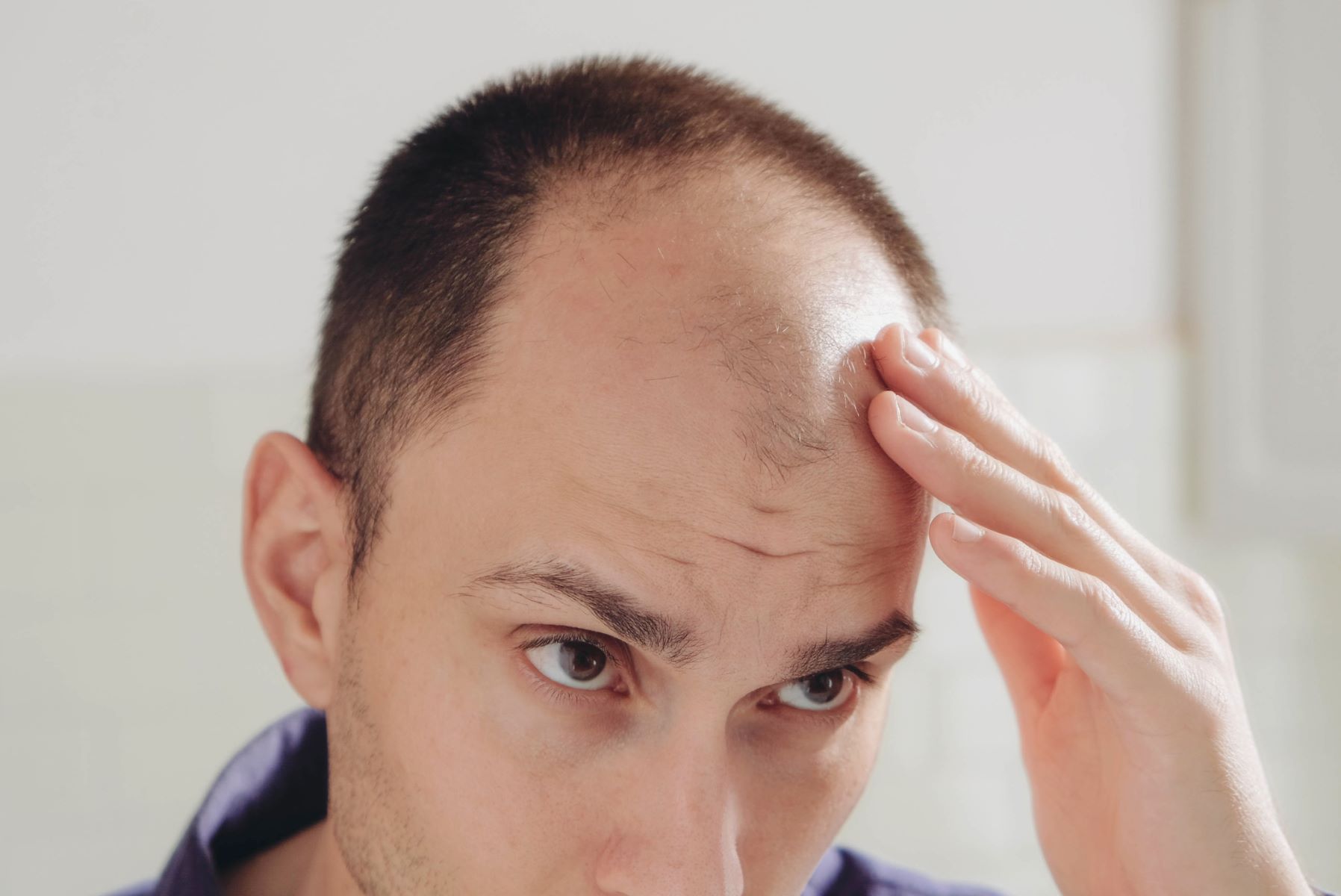 Man with androgenetic alopecia