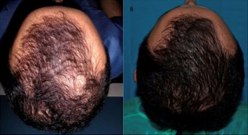 PRP hair treatment before and after