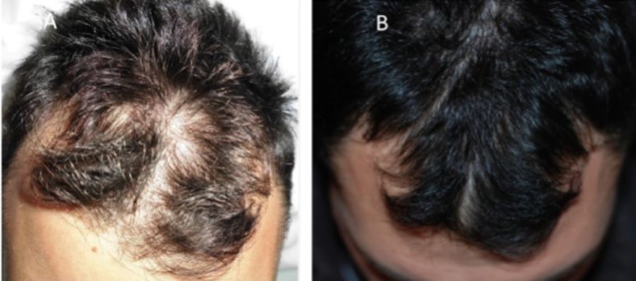 Patient before and after PRP hair treatment