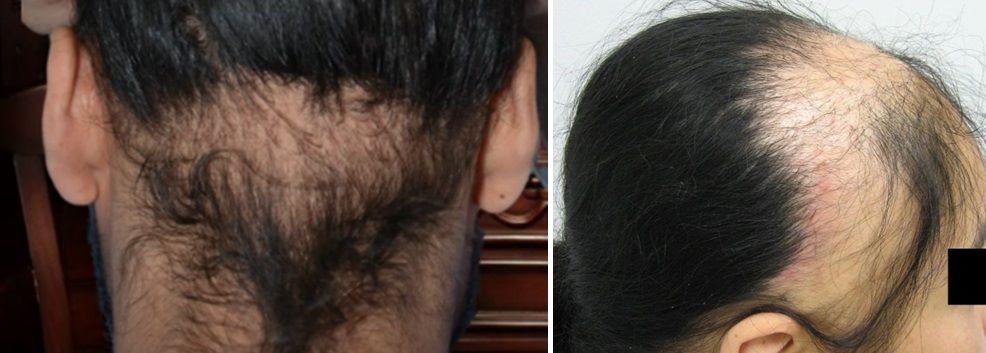 Patients with traction alopecia