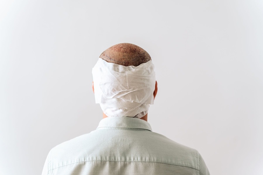 When Can I Remove My Hair Transplant Bandage?