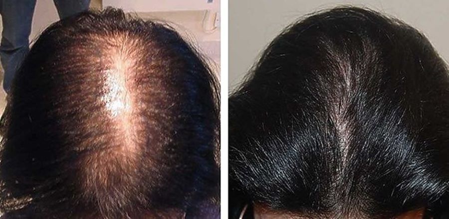 Woman before and after hair transplant at Wimpole Clinic