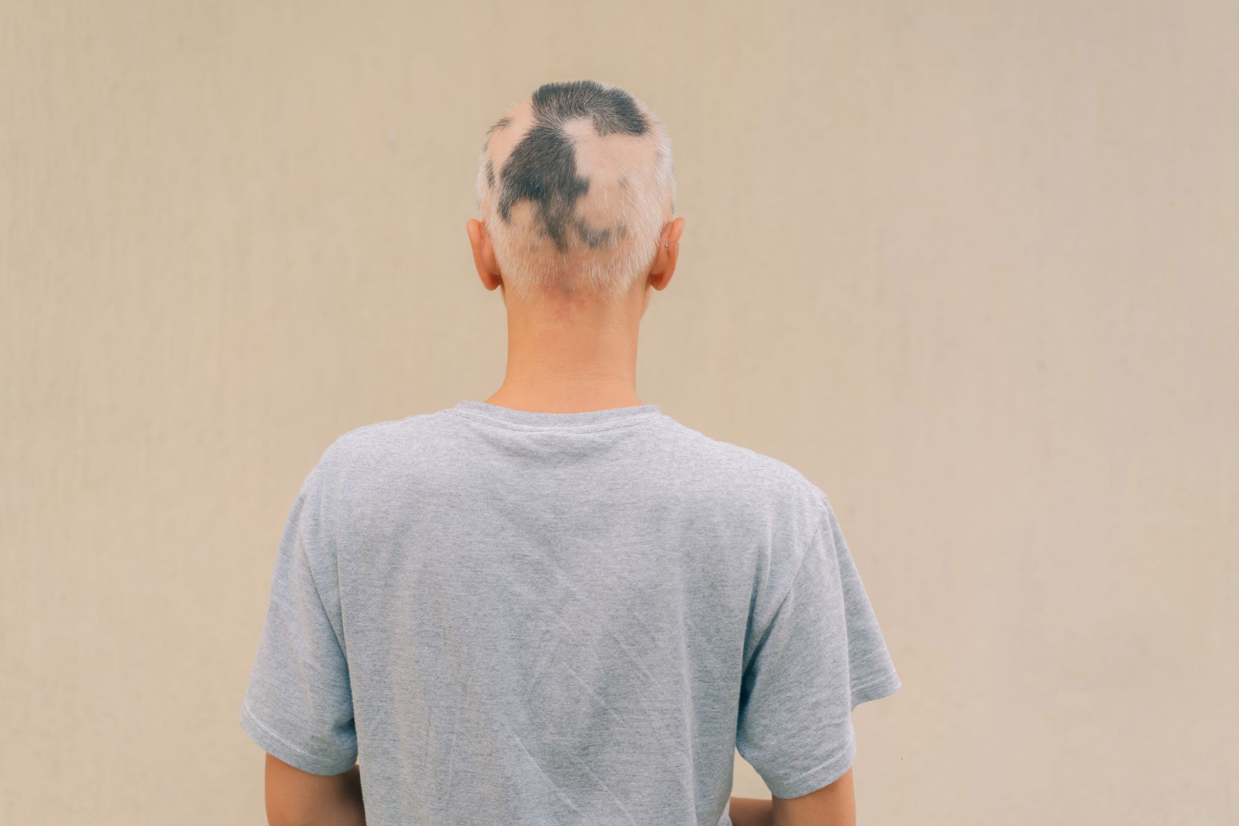 Woman with alopecia areata