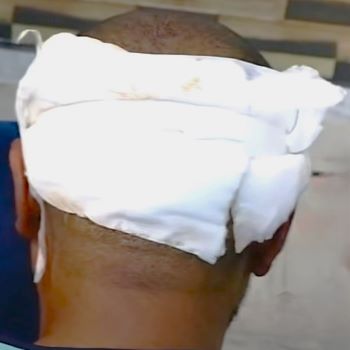 Man with a hair transplant bandage