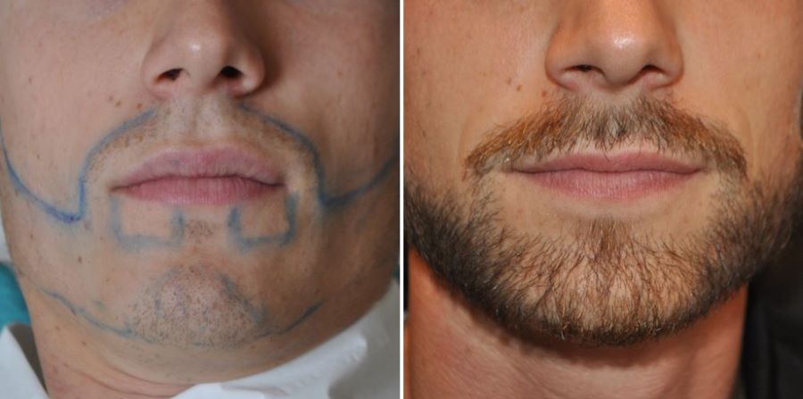 Beard transplant before and after