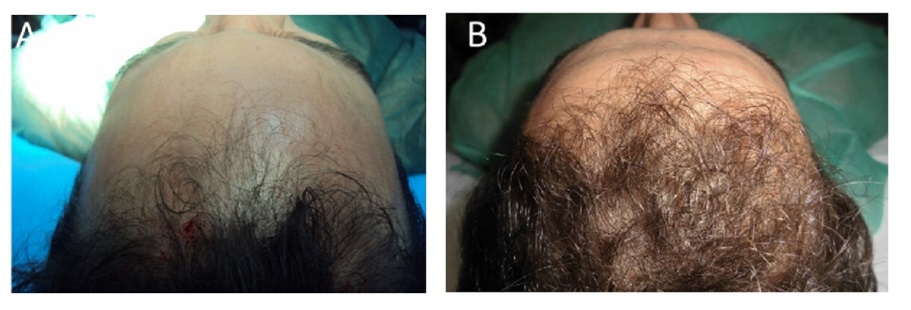 Before and after 3 months of PRP hair treatment.