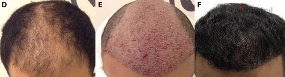 Before and after a DHI hair transplant