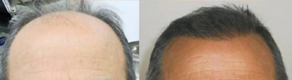 DHI hair transplant results