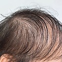 Diffuse Unpatterned Alopecia: Causes, Symptoms, Treatment