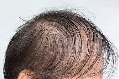 Diffuse Unpatterned Alopecia: Causes, Symptoms, Treatment