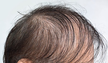 Diffuse Unpatterned Alopecia: Causes, Symptoms, Treatment