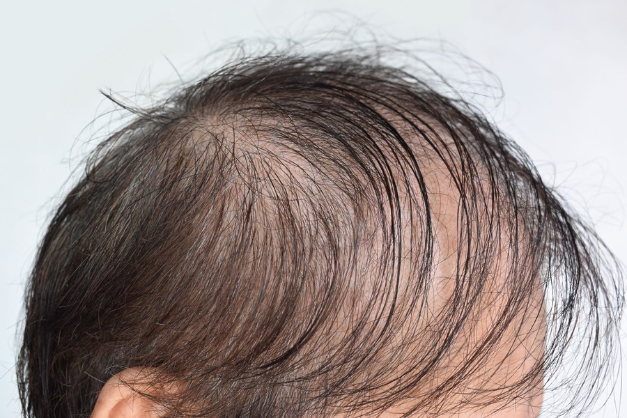 Diffuse Unpatterned Alopecia: Causes, Symptoms, Treatment