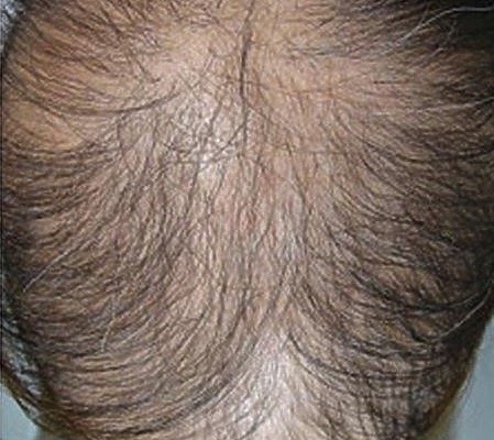 Diffuse Unpatterned Alopecia: Causes, Symptoms, Treatment