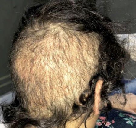 FUE hair transplant overharvesting