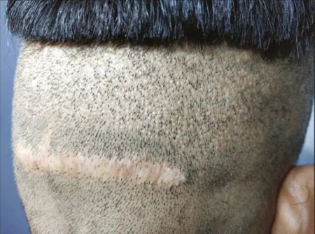 FUT hair transplant overharvesting