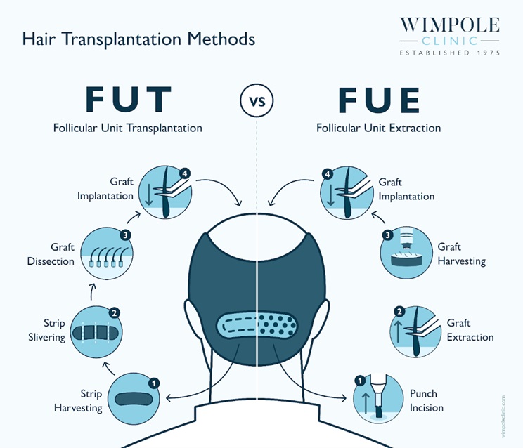 FUE vs FUT hair transplant