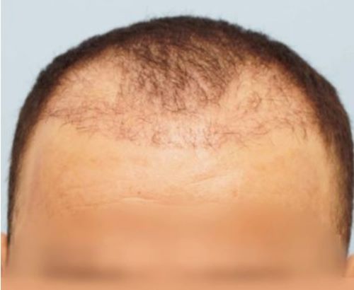 Failed hair transplant