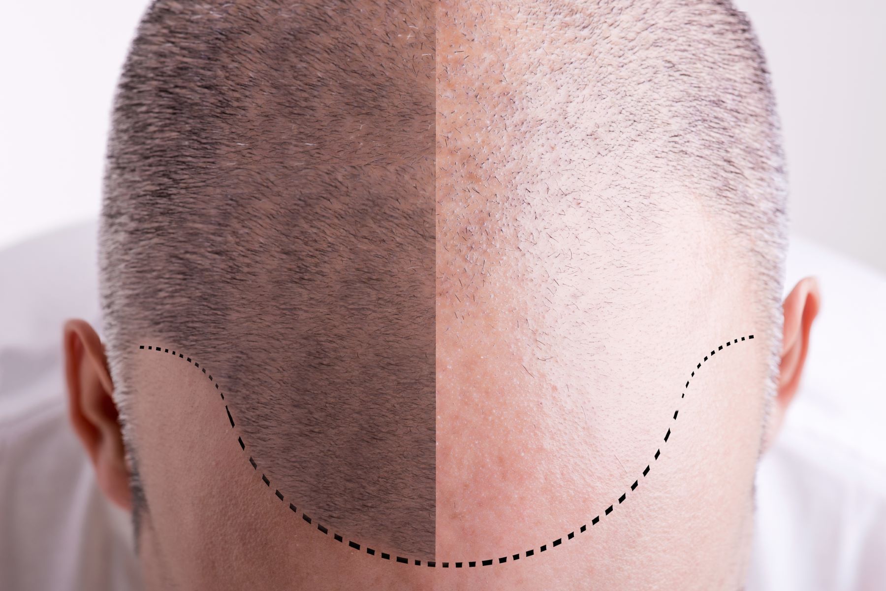 Hair transplant for receding hairline