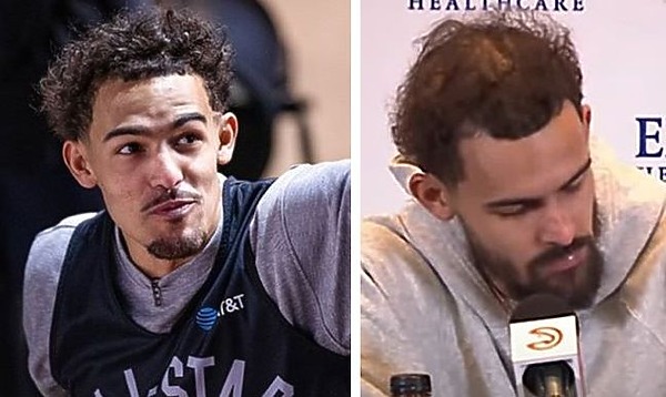 Is Trae Young Balding? How His Hair Has Changed