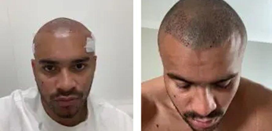 Jonathan Joseph 1-2 days after hair transplant