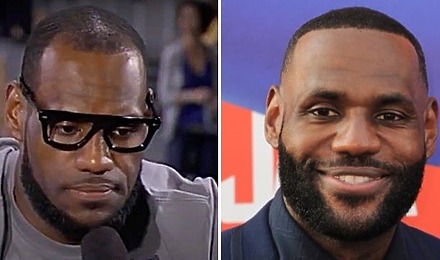 LeBron James’ Hairline: Did LeBron James Have A Hair Transplant?