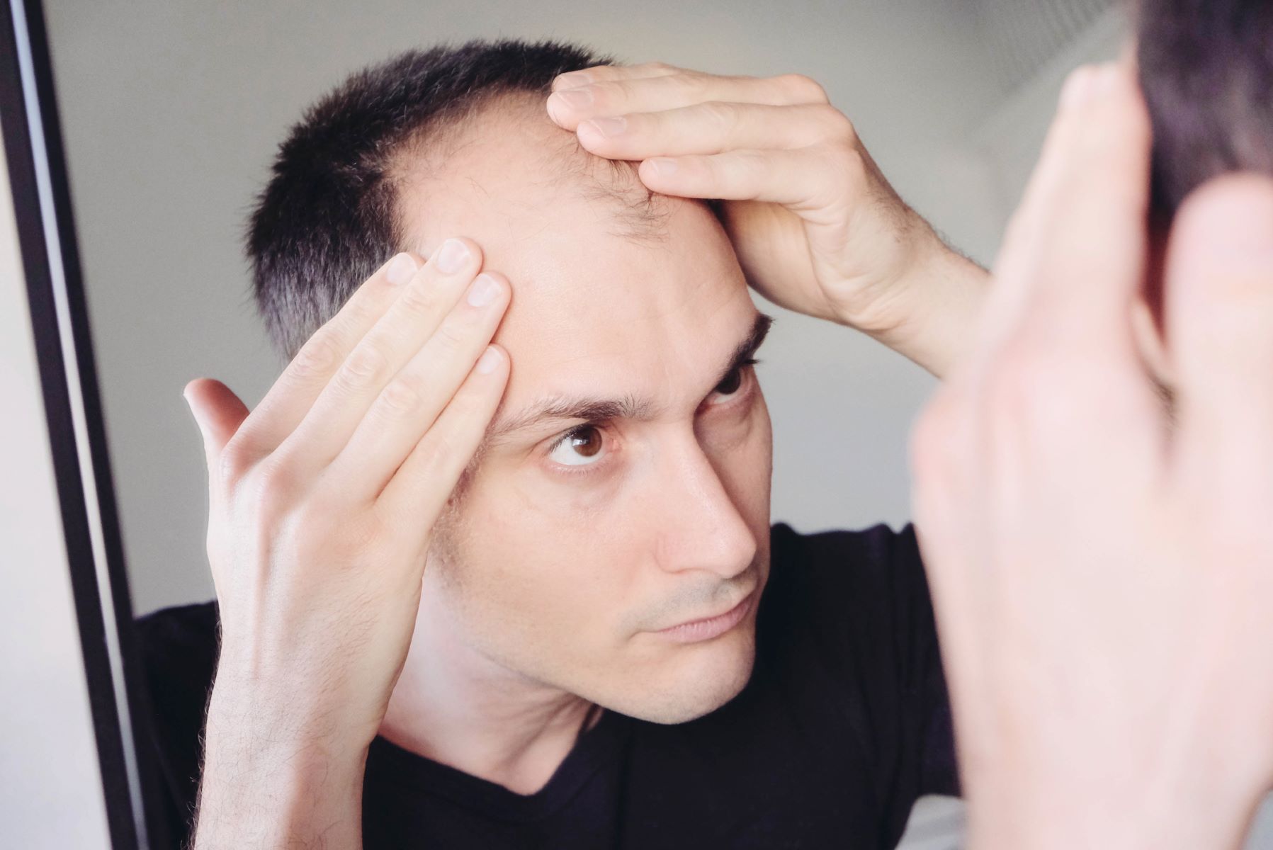 Man with dead hair follicles from androgenetic alopecia