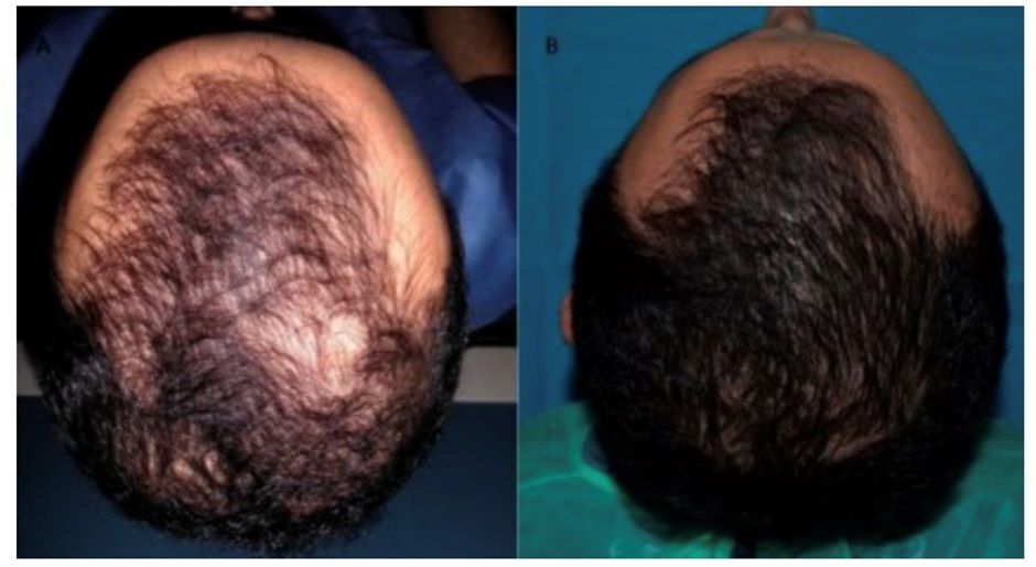 Patient before and after PRP hair treatment