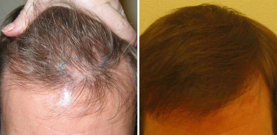 Patient before and after a hair transplant at Wimpole Clinic