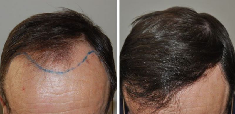 Patient before and after hair transplant