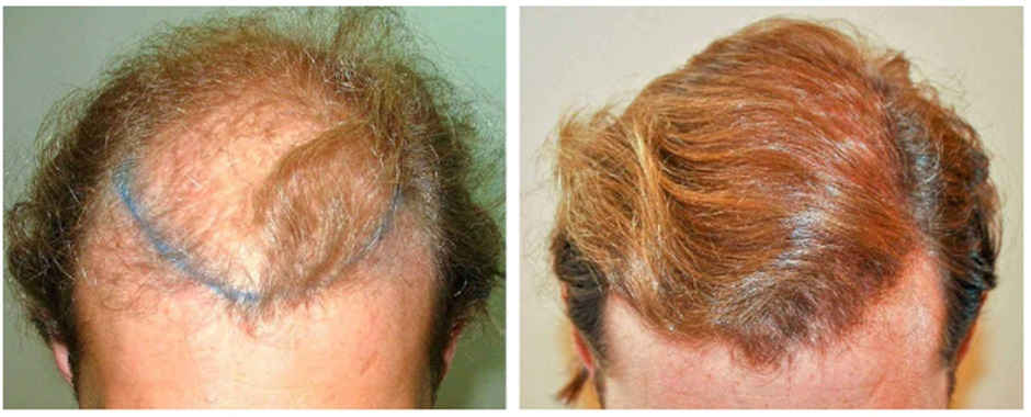 Patient before and after hair transplant at Wimpole Clinic