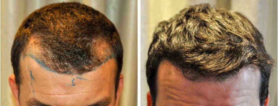 Patient before and after hair transplant at Wimpole Clinic