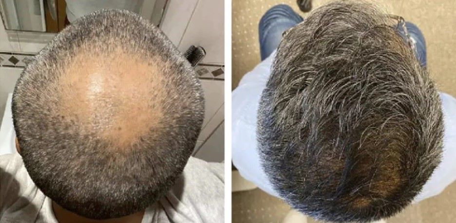 Patient before and after hair transplant