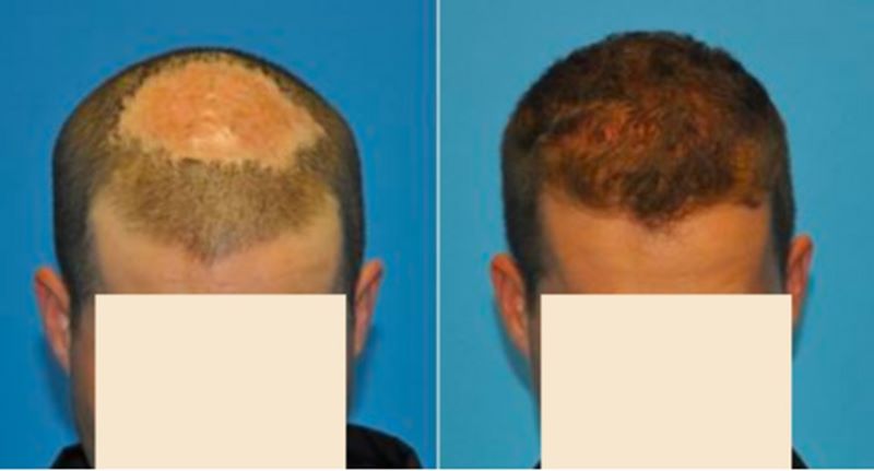 Patient before and after scar tissue hair transplant