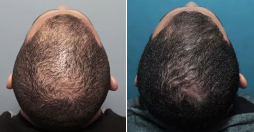 Patient before and after stem cell hair treatment