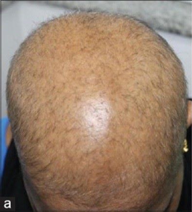 Patient with diffuse alopecia areata