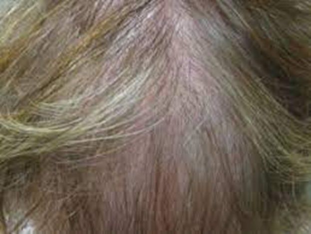 Patient with diffuse unpatterned alopecia