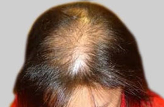 Patient with female pattern baldness