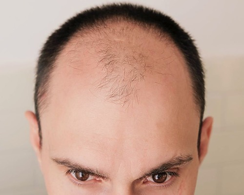 Patient with male pattern baldness