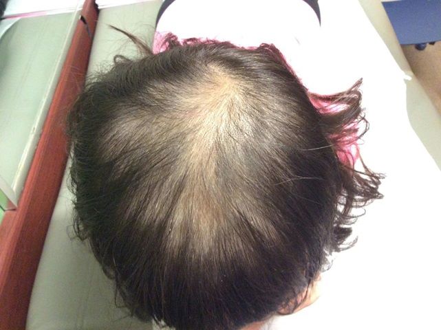 Patient with thyroid hair loss