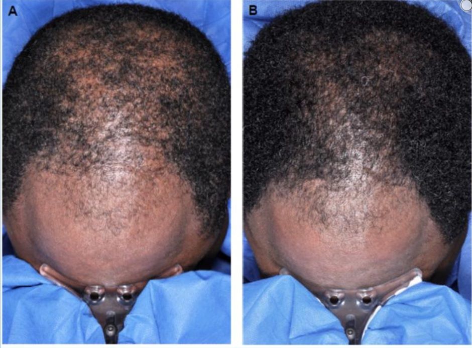 Topical minoxidil before and after